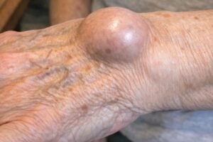 Doctors reveal that if you develop this strange lump on your wrist overnight, it means that you have …