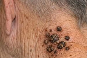 Silent Warning On Grandpa’s Neck