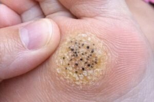 My daughter is limping from this hard rough spot with black dots on her sole. She has a dance recital tomorrow and is crying in pain. Need a fast fix!