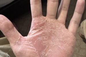 If This Appears on Your Hands, Be Careful. It Means You Have Ca…