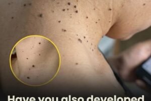 Why Skin Tags Appear