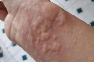 When Hives and Breathing Changes Appear Together