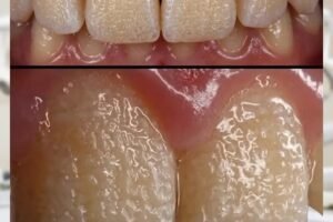 Can Rice Help Improve the Appearance of Teeth? Exploring a Popular Home Method