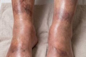 These are consequences of sleeping with…