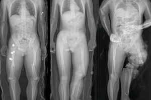 The Truth Behind Social Media Scares About COVID Vaccines”