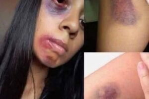 Dangerous Online Challenges: Teen Hospitalized After Experimenting with Foreign Objects