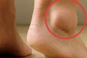 Seniors with Swollen Feet