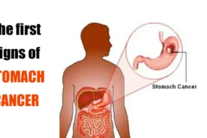 Cancer in the stomach develops silently. These are the first signs! You should be attentive!