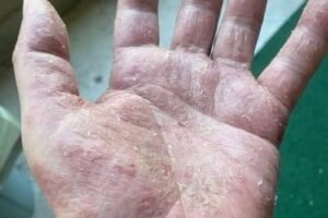 The Silent Cry Of Your Skin Why Those Red Patches On Your Hands Are Actually A Danger Signal You Cannot Afford To Ignore