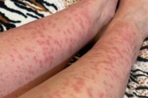 The Unseen Guest: Navigating a Persistent Bed Bug Infestation