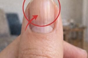 Doctor Uncovers A Telltale Sign In Your Fingernails That May Predict Your Life Expectancy