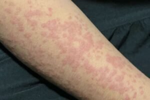 I Started Getting Mysterious Itchy Bumps