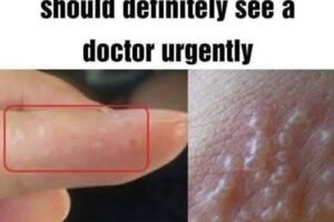 If you see these painful red bumps, you may have dyshidrotic eczema
