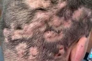 These are the first symptoms