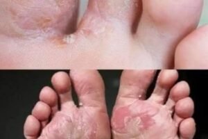 Warning Signs on Your Feet That Could Point to Hidden Diabetes