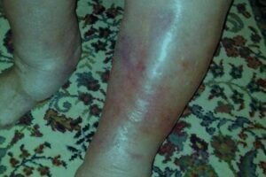 What That Sudden Red Patch on Your Skin Could Be Telling You About Your Health