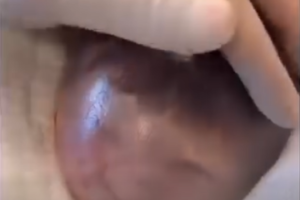 Baby Born Clutching Mother’s IUD: A Rare and Astonishing Birth Story