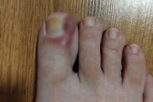 How to Treat an Ingrown Toenail at Home: Tips and Natural Remedies