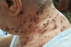 The Silent Virus Within: Understanding Shingles and How to Take Control of Your Health