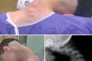 Neck Collapse Alert: Young Man Hospitalized with Dropped Head Syndrome