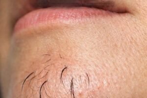 What Chin Hair in Women Really Says About Horm:ones
