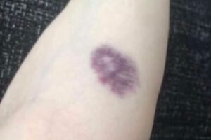 BE CAREFUL, if you get these bruises on your body, it means you have Ca…see more