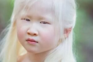 A baby girl born with albinism was abandoned by her parents. She looked too “weird” for them and left her at an orphanage door. Try not to smile when you see her today: check in comments👇👇👇