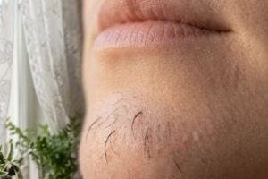 What Chin Hair in Women Really Says About Horm:ones