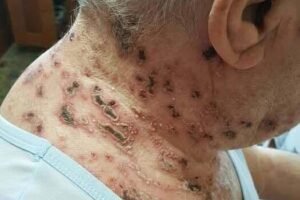 This is the silent disease that is triggered when you come into contact with … See more