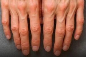 Visible Veins? Here’s What They Could Be Telling You About Your Health