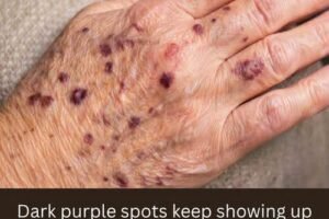 Dark purple spots keep showing up on my hands, and my doctor appointment is weeks away. What should I do in the meantime?