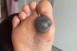 My daughter woke up with this huge spot on her foot I don’t know what it could be. She’s been in pain and can’t move her foot what is this.. Explain this