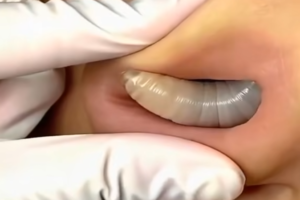 Larvae found in a young woman…See more