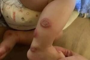When a Rash Speaks Louder Than Words: A Real Case of Sweet Syndrome That Shook a Family