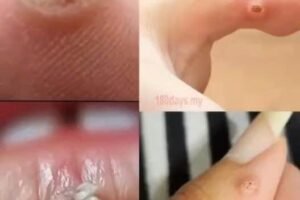 Be very careful if it comes out in your mouth, you are infected