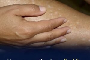 What Vitamin Deficiencies May Lead to White Spots o