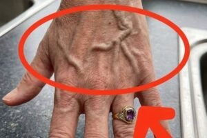 What Bulging Veins Can Mean