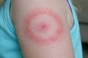 My Daughter Woke Up With a Strange Red Ring on Her Arm: A Parent’s Guide to Ring-Shaped Rashes (And When to Breathe Easy)