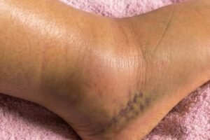 The Silent Danger Beneath Your Skin: Why Your Swollen Legs Are Screaming for Help