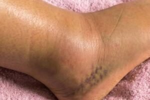 Swollen Legs: Understanding the Symptoms, Causes, and Treatments