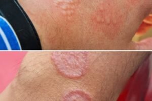 The Hidden Agony: Why Your Groin Irritation Could Be More Than Just a Minor Annoyance