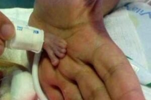 Born Far Too Soon, His Fight Began in an Ambulance