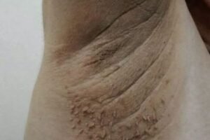 Understanding Dark Patches on the Skin: A Gentle Guide to Acanthosis Nigricans and When to Seek Care
