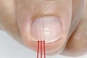 If you have these lines on your nails after the age of 40, it is a clear sign that…
